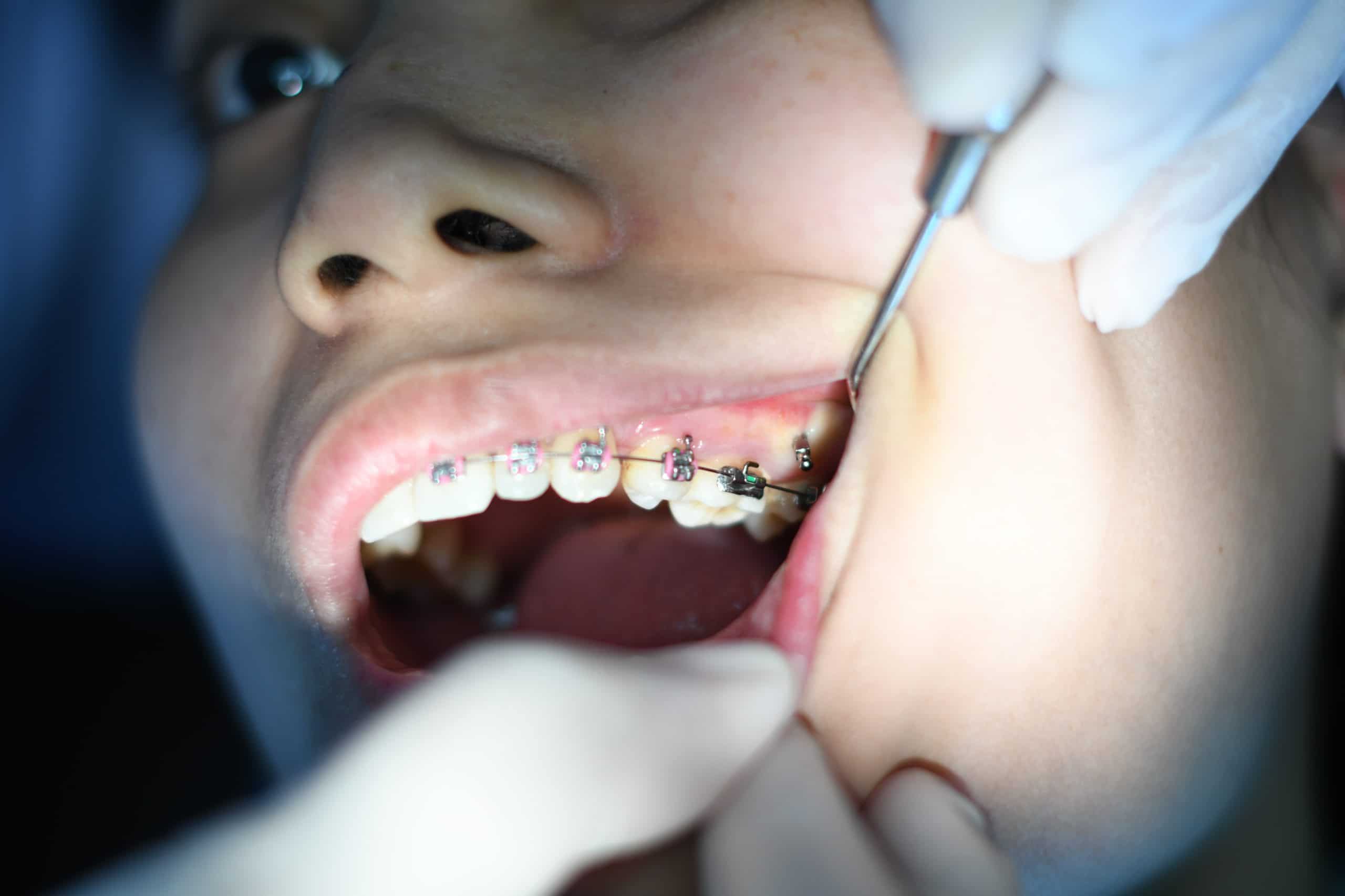 Leia mais sobre o artigo Tooth Extraction – the  final destination
